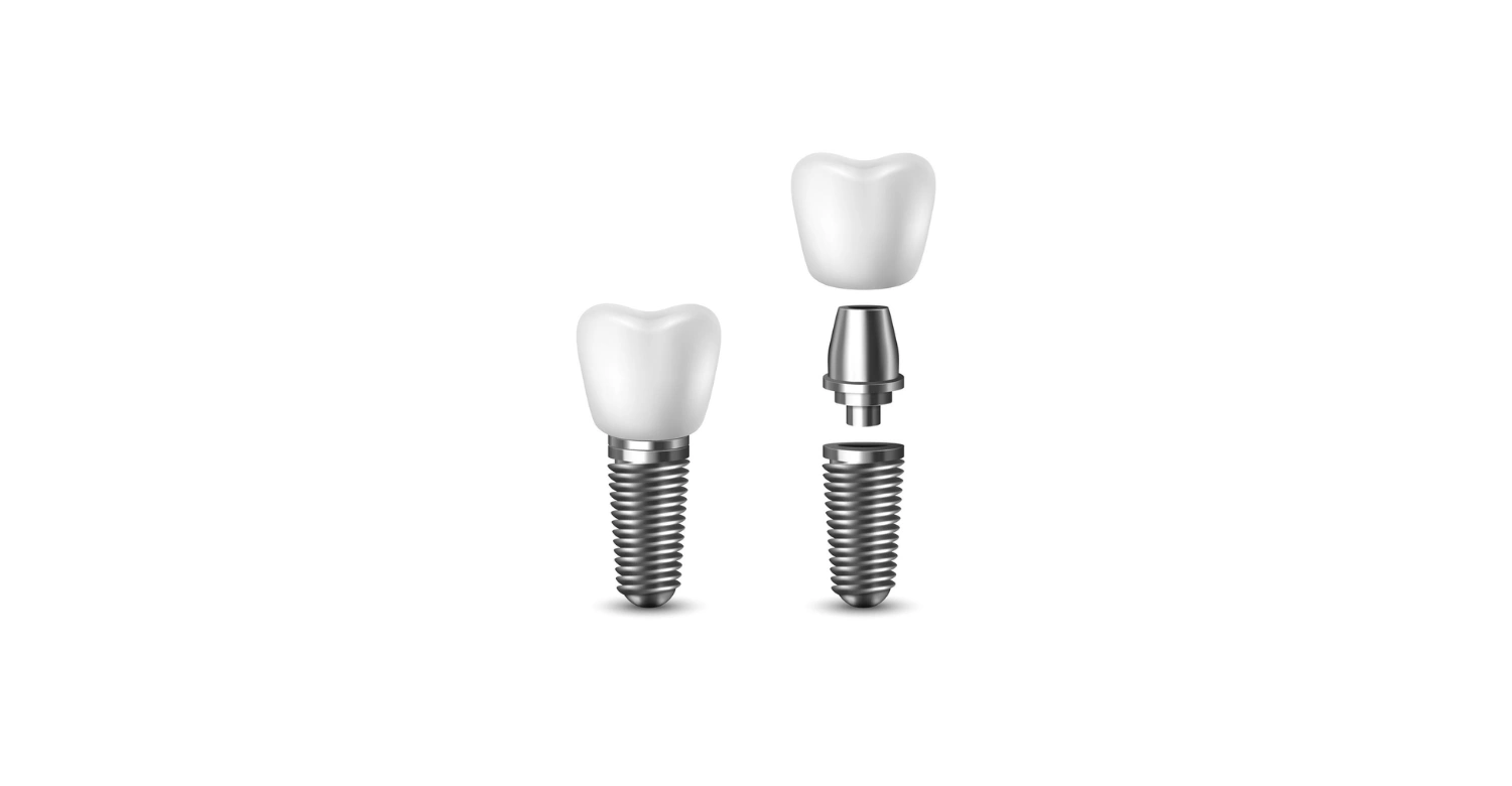What Are Dental Implants Made Of